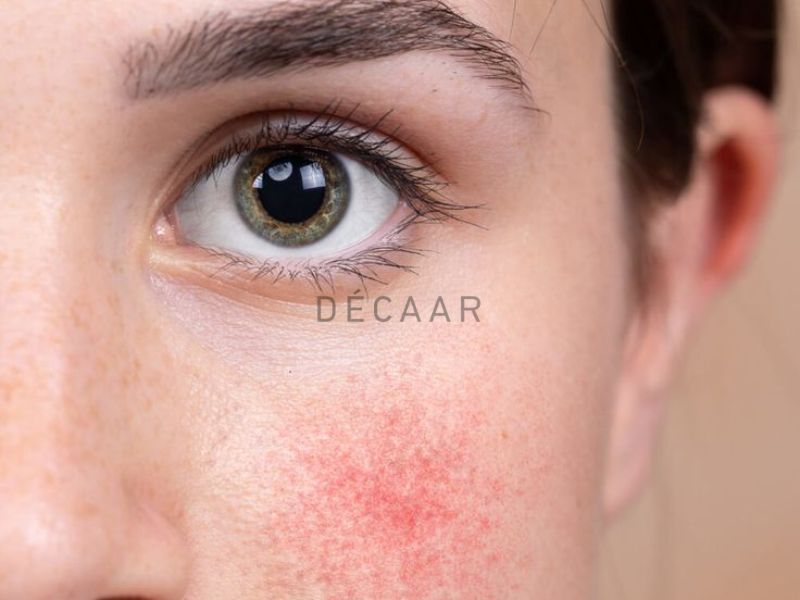 dấu hiệu da bị nhiễm corticoid nhẹ